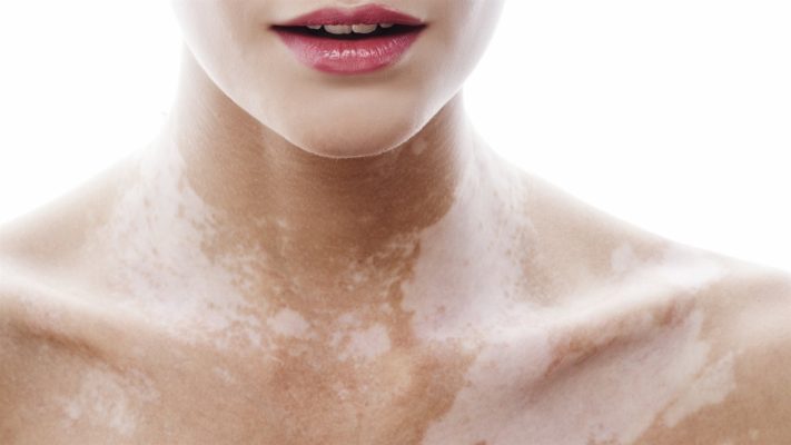 витилиго лечение 2018 лекарство