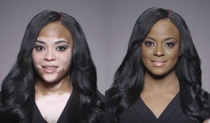 Диагностика витилиго