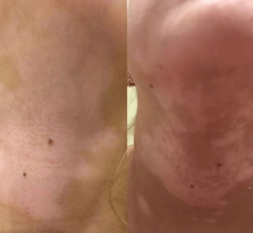 Дермалайт 311 - инновации на службе вашей красоты Реальный результат Дермалайт 311 лампа