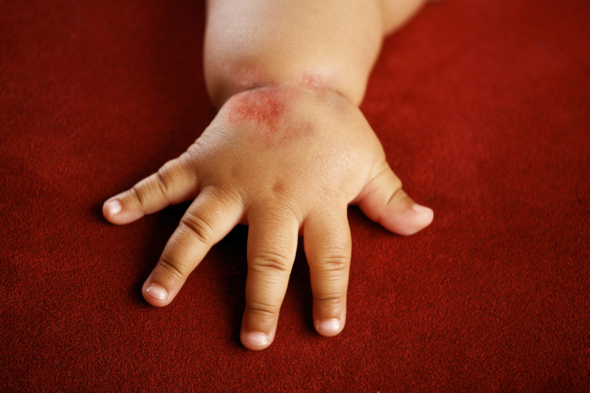 Лечение дерматита у детей лампами thumbnail