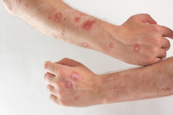 Стадии псориаза и его лечение | Магазин Vitimed