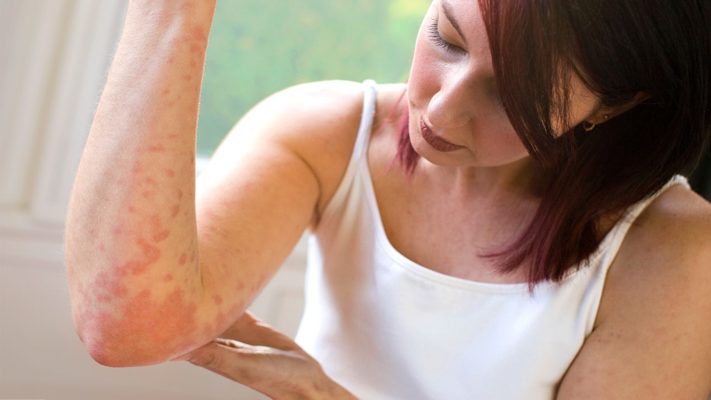 Причины псориаза