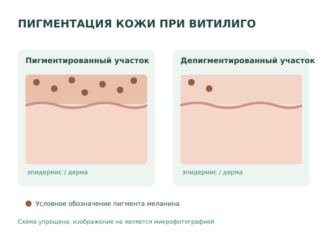 Процесс появления витилиго 