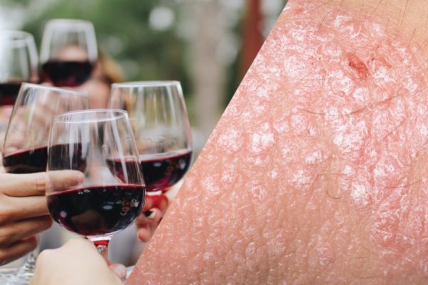 Псориаз и праздники