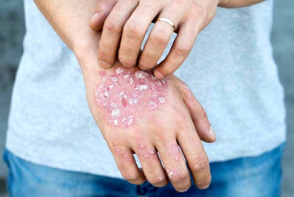 Симптомы и лечение псориаза у взрослых