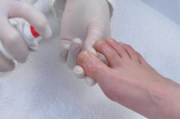 Как правильно устранить грибок ногтей на ногах: врачи против лечения в домашних условиях