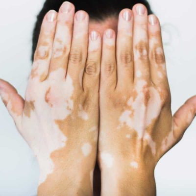 Лечение витилиго в 2021 году 1 что такое витилиго? 2021 год