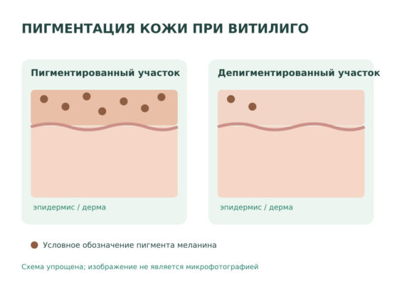 Витилиго - что это за болезнь, лечение.