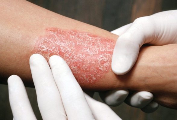 Чешуйчатый псориаз