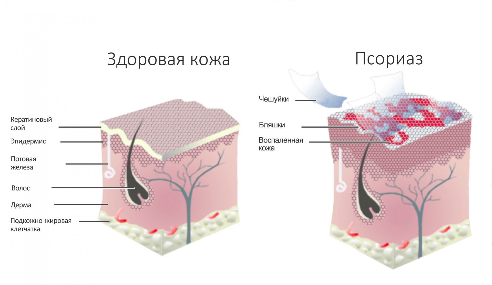 Псориаз на ступнях - Vitimed