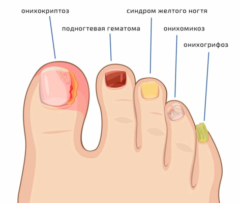 Лечение грибка ультрафиолетом 1 лечение грибка