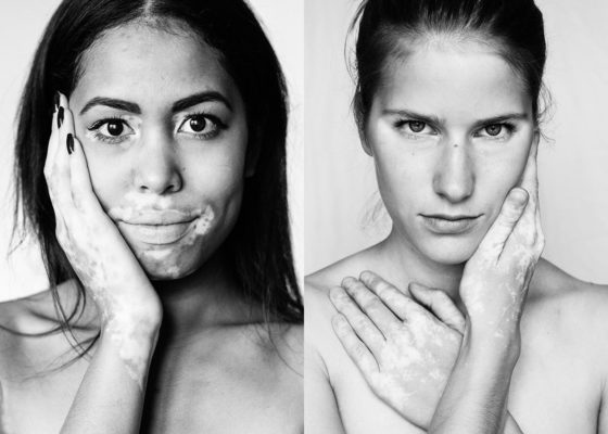 Витилиго - что это за болезнь, лечение.