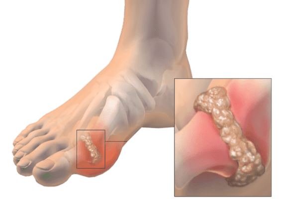 Псориатический артрит на пальцах ног 