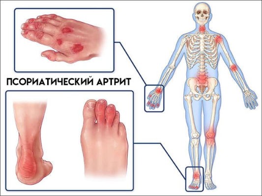 Псориатический артрит