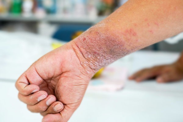 Чешуйчатый лишай лечение