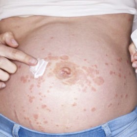 Может ли женщина лечить псориаз во время беременности или кормления грудью? Беременная женщина с псориазом