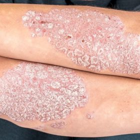 Что такое псориаз? Что такое псориаз