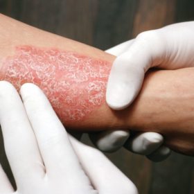 В чем разница между экземой и псориазом? В чем разница между экземой и псориазом?