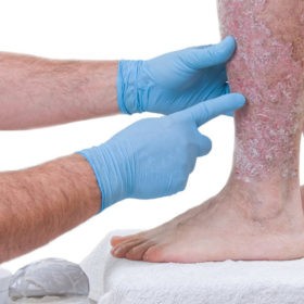 Можно ли лечить псориаз мужчинам во время зачатия? Можно ли лечить псориаз мужчинам во время зачатия?