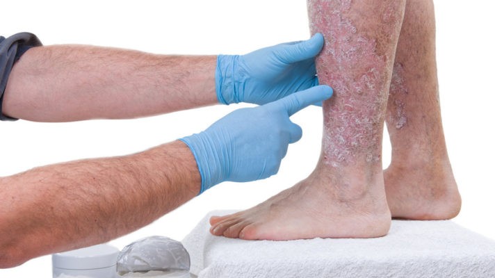 Можно ли лечить псориаз мужчинам во время зачатия?