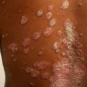 Можно ли заразиться псориазом, если у вас смуглая кожа? Статья