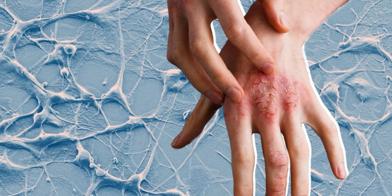 Нужно ли лечить псориаз?