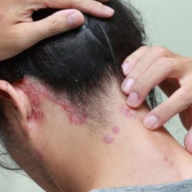 Причины появления псориаза