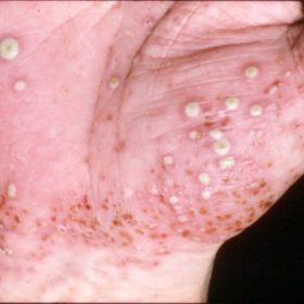 Пустулезный псориаз: виды лечения