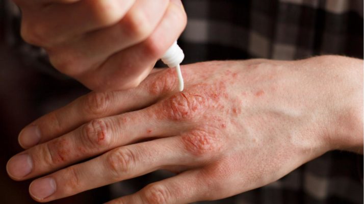 vidy psoriaza mozhet li u vas byt bolshe odnogo 1