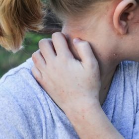 Может ли быть псориаз у детей? Может ли быть псориаз у детей