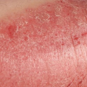 Как лечить генитальный псориаз