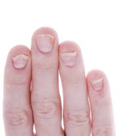 Лечение псориаза ногтей