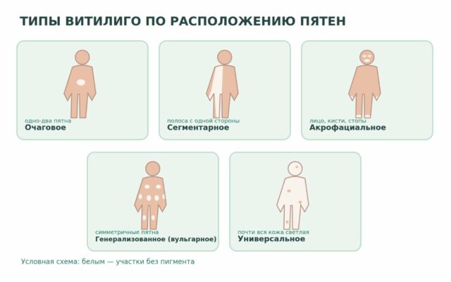 Типы витилиго: признаки и симптомы