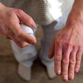 Лечение псориаза полезные советы