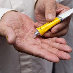 Лечение псориаза у пожилых людей