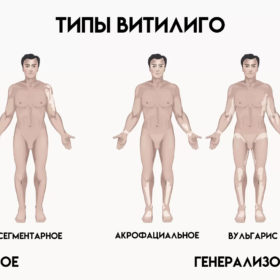 Типы витилиго: признаки и симптомы типы витилиго